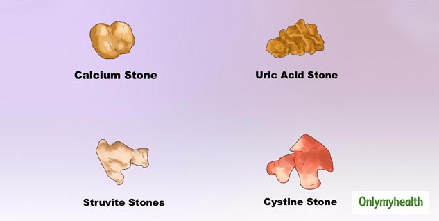 Can Laser Lithotripsy Help In Treating Sizeable Kidney Stones In A ...