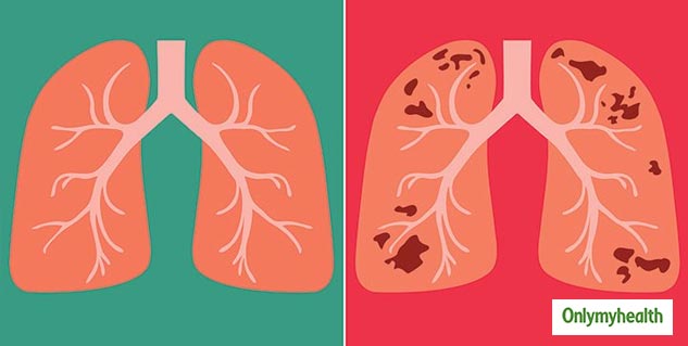 TB And Coronavirus: Extra Care For TB Patients During COVID-19 Outbreak