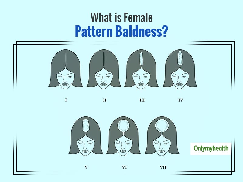 Female Pattern Hair Loss: Symptoms, Stages And Treatment