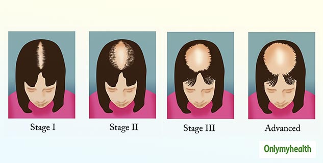 Female Pattern Hair Loss Symptoms Stages And Treatment Onlymyhealth 