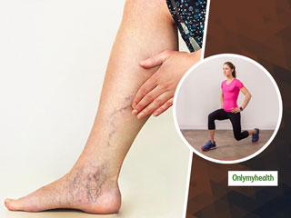 Varicose Veins: टेढ़ी-मेढ़ी और उभरी हुई पैर की नसों को ठीक कर देंगी ये 3 एक्‍सरसाइज, जानिए करने का तरीका