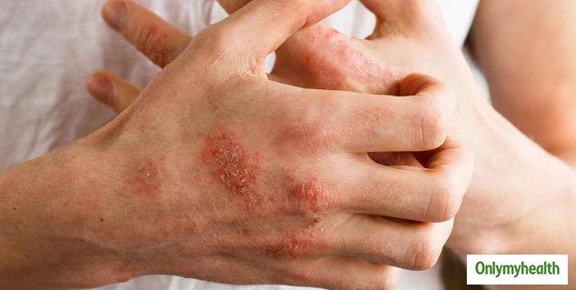 Seborrheic Eczema Symptoms 