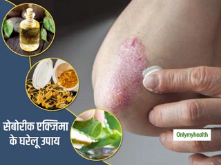 Home Remedies For Seborrheic Eczema: डर्मटॉलजिस्ट से जानें सेबोरीक एक्जिमा से निपटने के 3 असरदार घरेलू उपाय 