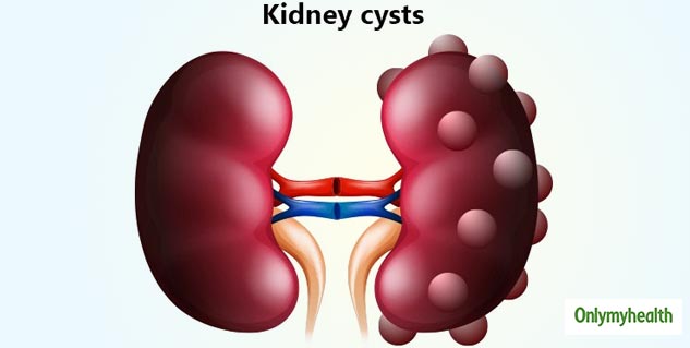 kidney cysts