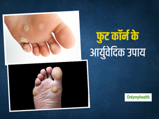Foot Corns: पैरों में कील या फुट कॉर्न्‍स (Foot Corns) के इलाज में मदद करेंगे ये 5 आयुर्वेदिक घरेलू उपाय 