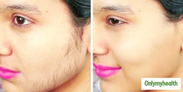 insideunwantedhairsonface