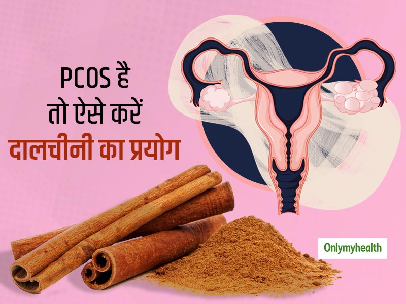 महिलाओं में पीसीओएस Pcos की समस्या का आसान घरेलू उपचार है दालचीनी जानें इस्तेमाल के 3 तरीके 9546