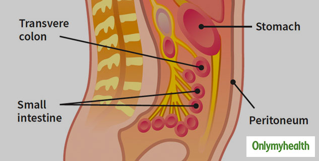 Peritoneal Cancer Risk Factor 