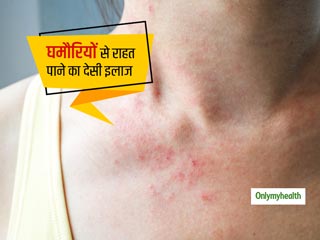 गर्मियां आते ही पीठ, हाथ और जांघ पर होने लगी घमौरियां, इन देसी उपाय से पाएं राहत और दूर भगाएं जिद्दी घमौरियां 