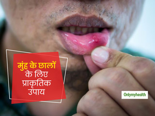 गर्मियों में मुंह के छालों से हैं परेशान? इन 5 घरेलू नुस्खों से पाएं तुरंत राहत और दूर करें दर्द और जलन  