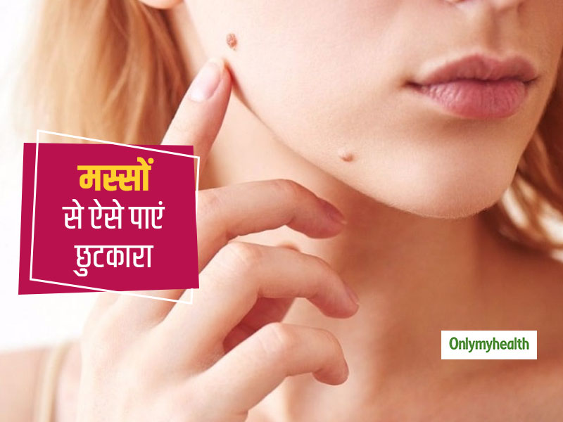 ये घरेलू उपचार दिलाएंगे आपको मस्सों से निजात, जानें इसे इस्तेमाल करने का तरीका