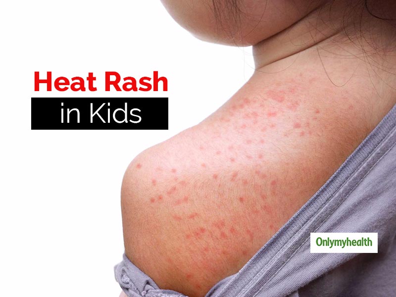 How to treat a heat rash in toddler