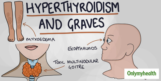 World Thyroid Day 2020: Watch Out For These Thyroid Symptoms In Men ...