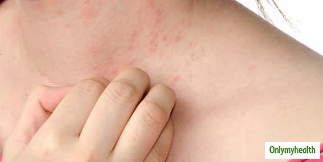 Heat Rash In Kids: Try These Effective Natural Treatments For Relief