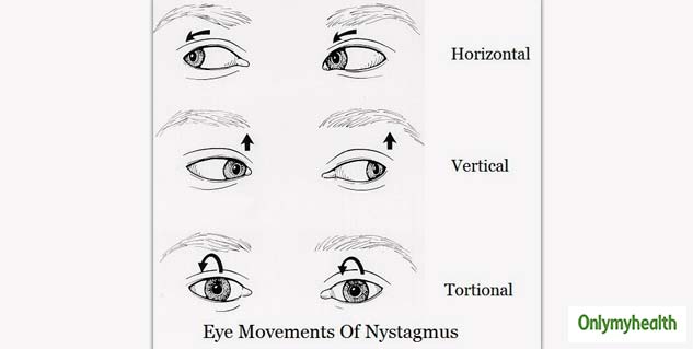 Here’s What Can Be Done To Control The Uncontrolled Eye Movements ...