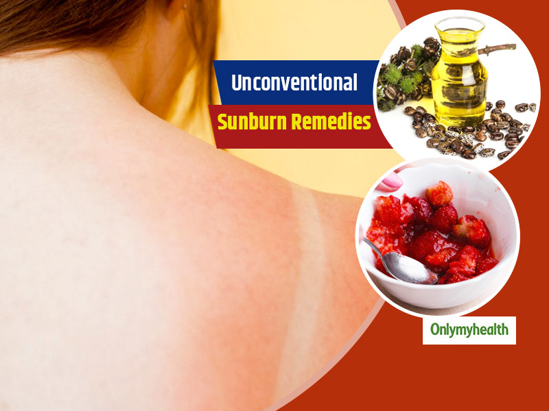 Sunburn Home Remedies: 5 Things That You Didn't Know Could Heal