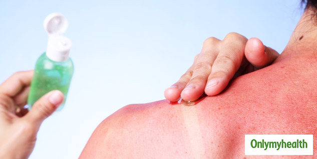 Sunburn Home Remedies: 5 Things That You Didn't Know Could Heal Sunburnt  Skin