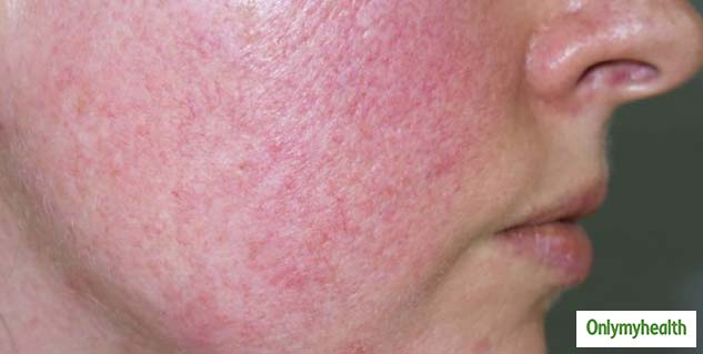 insideeczema