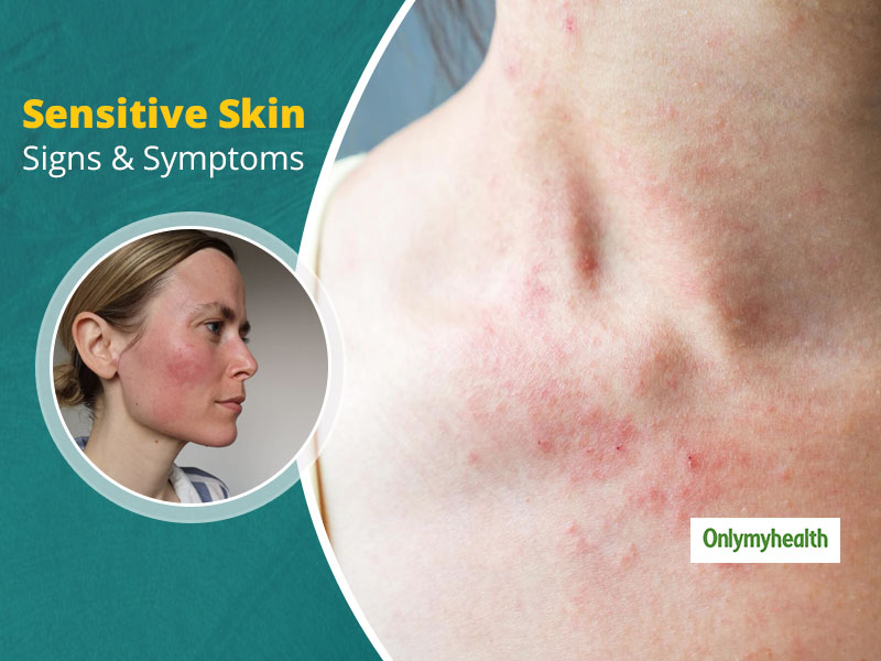 Is Your Skin Sensitive? Learn From These Signs And Symptoms 