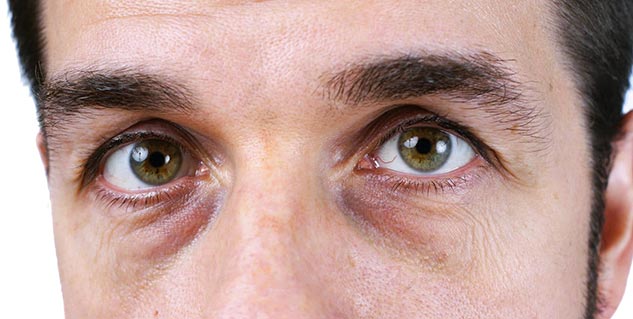 dark cicles causes and treatment