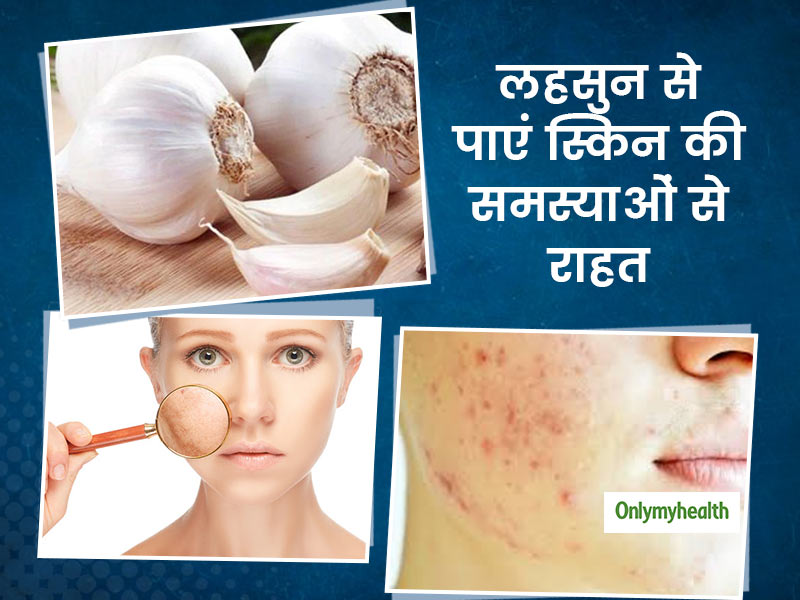लहसुन में छिपा है स्किन की इन 7 समस्याओं का रामबाण इलाज, जानें किस समस्या में कैसे करें इस्तेमाल