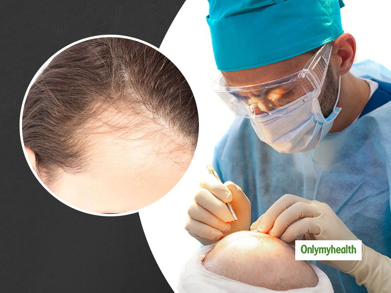 Hair Transplant Treatment: All You Need To Know About Its Procedure, Cost And Side-Effects