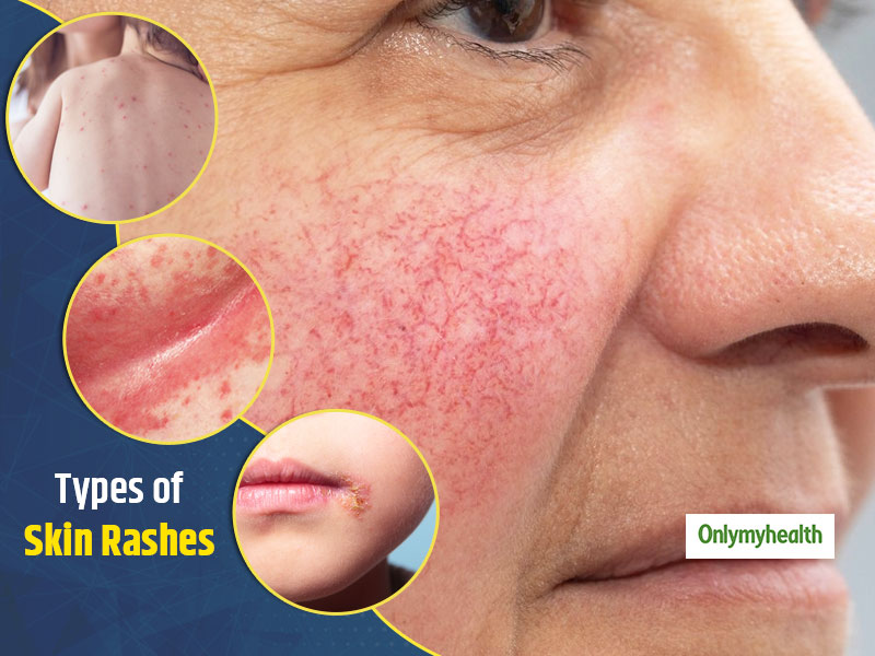 A Dermatologist S Guide To Types Of Skin Rashes Onlymyhealth