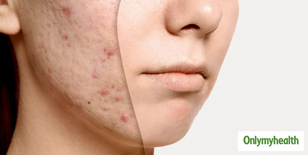 acne and scars treatment