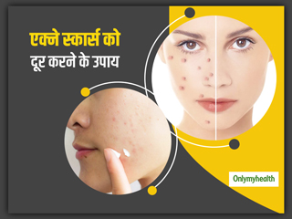 एक्‍ने स्‍कार्स से न बिगड़ जाए आपकी खूबसूरती, इसके लिए आजमाएं ये 5 प्राकृतिक उपाय