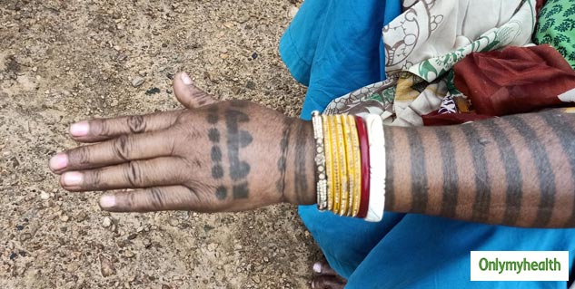 firaliasis symptoms in hindi