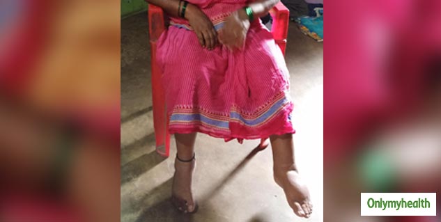 Lymphatic filariasis in Hindi