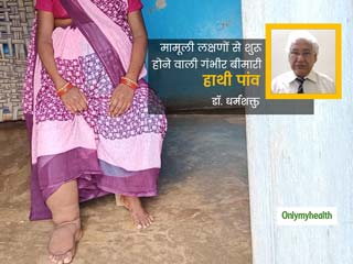 डॉक्टर से जानें मच्छरों से कैसे फैलता है फाइलेरिया (हाथी पांव) और क्यों खतरनाक है ये रोग