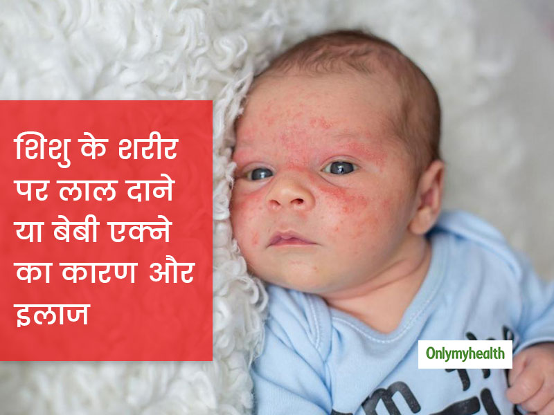 शिशु के शरीर पर दिख रहे हैं लाल दाने तो हो सकता है बेबी एक्ने का संकेत, जानें क्या है कारण और कैसे करें बचाव