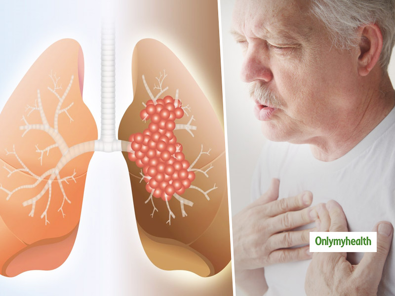 Lung Fibrosis: Know About The Risk Factors And Preventive Measures By ...