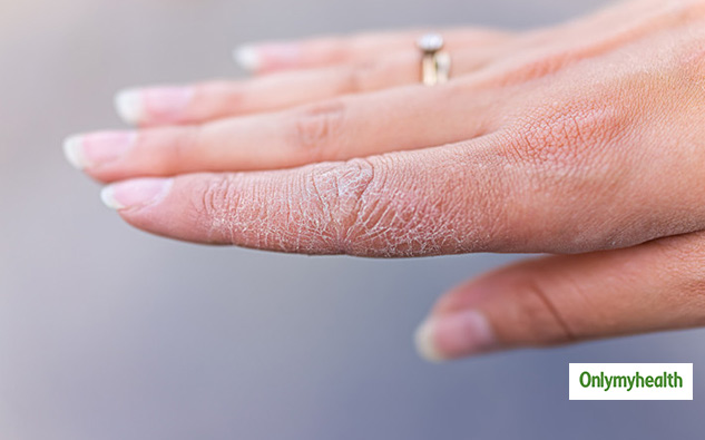 dry skin during winters