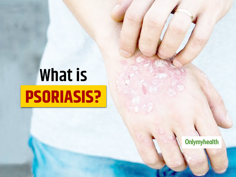 would you date someone with psoriasis