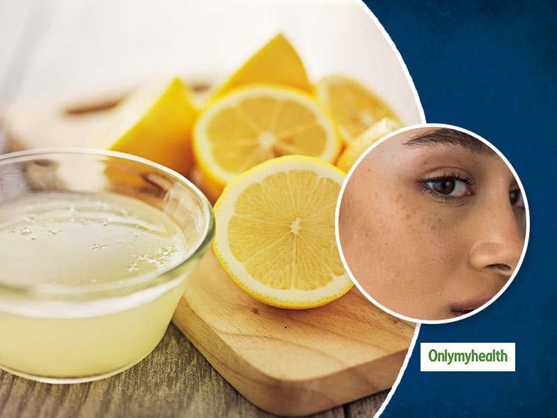 Aloe vera and clearance lemon juice for acne