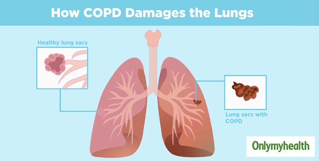 World COPD Day 2020: Know-Why Indoor Air Pollution Is A Major Cause Of ...