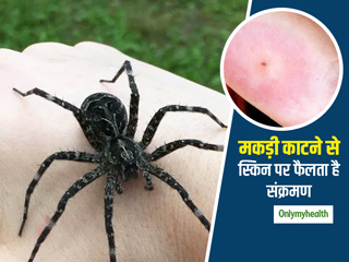 मकड़ी के काटने से स्किन पर फैल सकता है संक्रमण, इन घरेलू उपचार से पाएं राहत