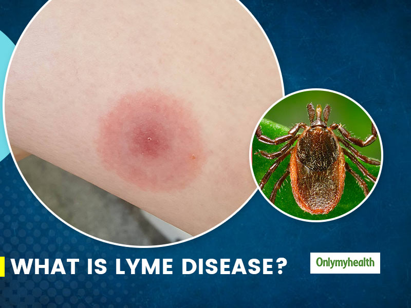 What Is Lyme Disease Here Are Its Causes Symptoms Pre - vrogue.co