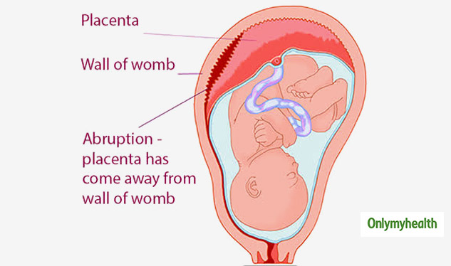 Pregnancy Care: Check Out These Causes Of Placental Abruption And Its ...