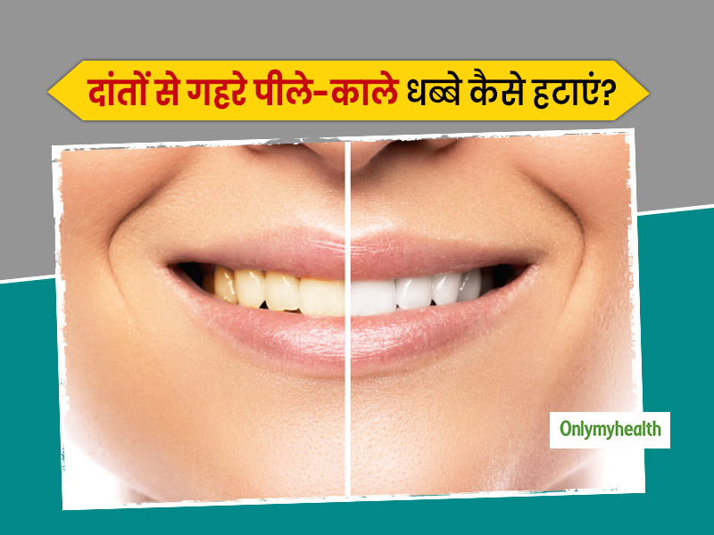 दांतों में जमा पीले-काले धब्बे (Plaque and Tartar) को साफ कर कैसे पाएं चमकते दांत? डेंटिस्ट से जानें आसान उपाय