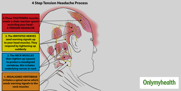 Tension Headache: What It Is, Causes, Symptoms & Treatment