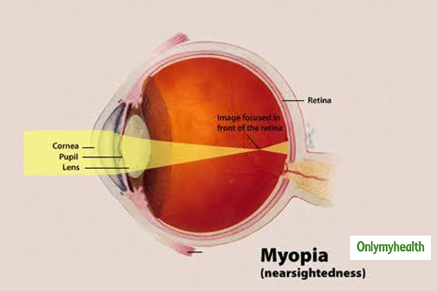 myopia-types-symptoms-causes-and-treatment-onlymyhealth