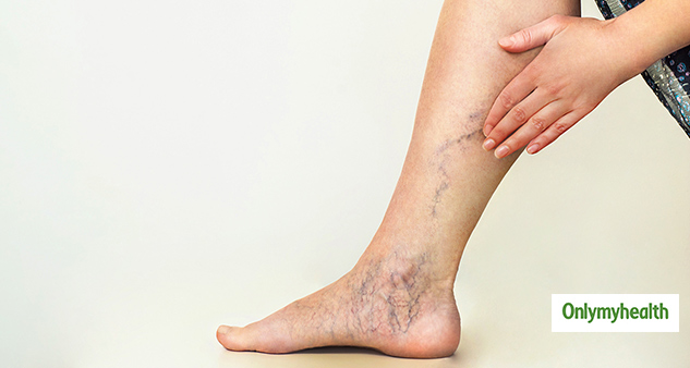 Varicose Veins