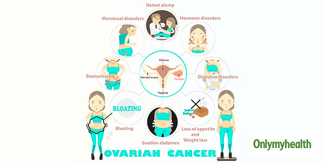 Ovarian Cancer Causes Symptoms Diagnosis And Treatment Onlymyhealth