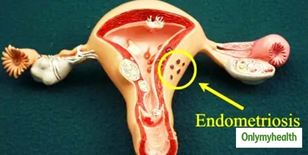 Ovarian Cyst 