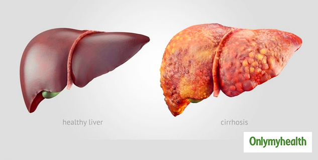 Alcoholic Liver Cirrhosis Signs