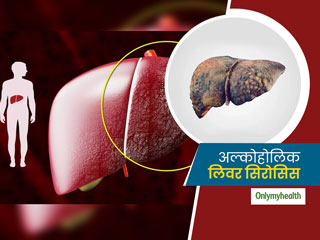 ज़रूरी नहीं कि पेट दर्द ही हो एल्कोहलिक लिवर सिरोसिस के संकेत, इन 5 लक्षणों पर भी करें गौर