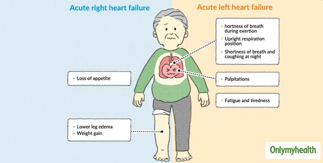 How Can One Treat Irreversible Damage To The Heart? | OnlyMyHealth